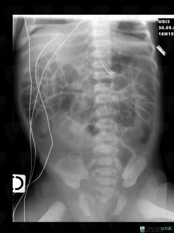 Imperforate anus, Rectum, X rays