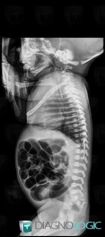 Imperforate anus, Rectum, X rays