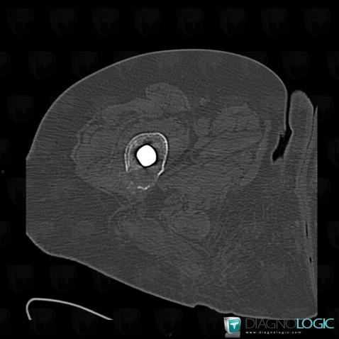 Implant loosening, Femur - Mid part, CT