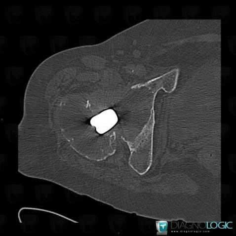 Implant loosening, Femur - Proximal part, CT