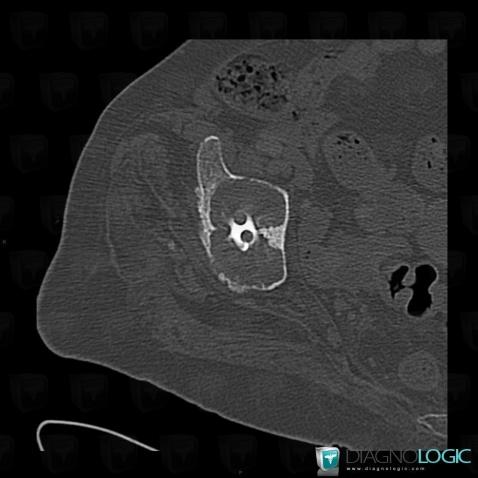 Implant loosening, Ilium, CT