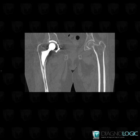 Implant loosening, Ilium, CT