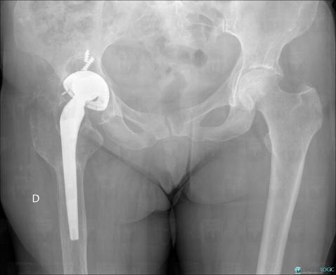 Implant loosening, Ilium, Femur - Proximal part, X rays