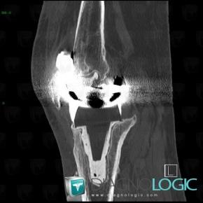 Implant loosening, Tibia - Proximal part, CT