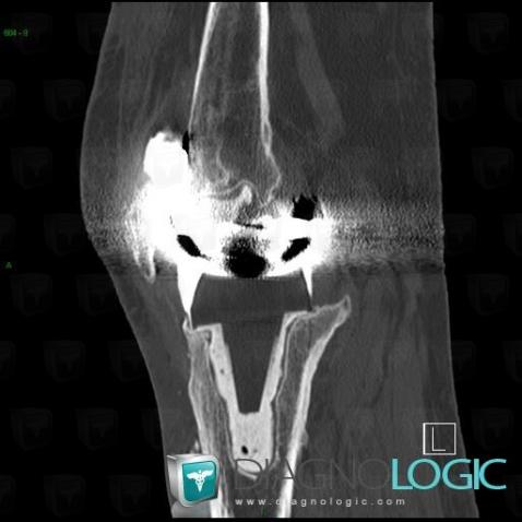 Implant loosening, Tibia - Proximal part, CT