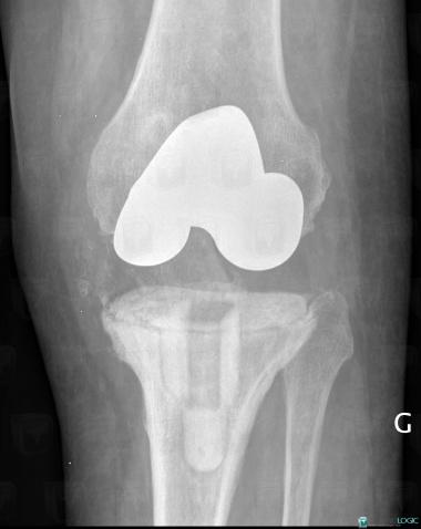 Implant loosening, Tibia - Proximal part, X rays