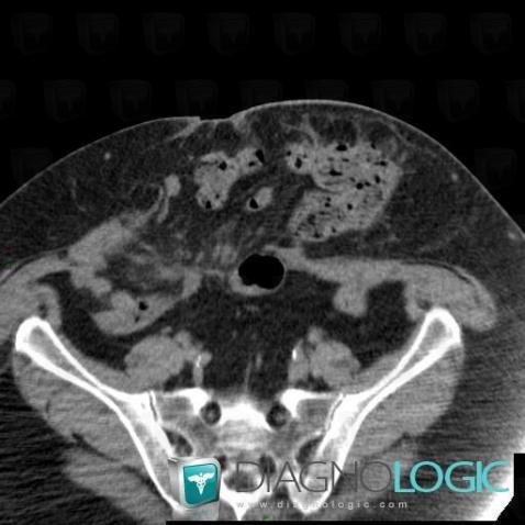 Incisional hernia, Abdominal wall, CT