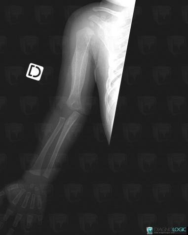 Infantile cortical hyperostosis, Humerus - Proximal part, Humerus - Mid part, X rays