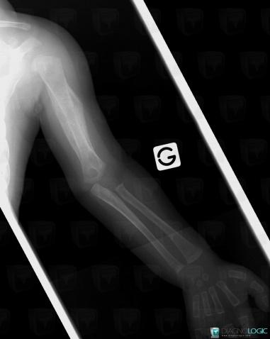 Infantile cortical hyperostosis, Humerus - Proximal part, Humerus - Mid part, X rays