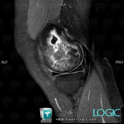 Infarctus osseux, Fémur -inférieur, IRM