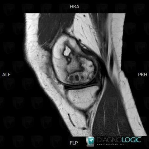 Infarctus osseux, Fémur -inférieur, IRM