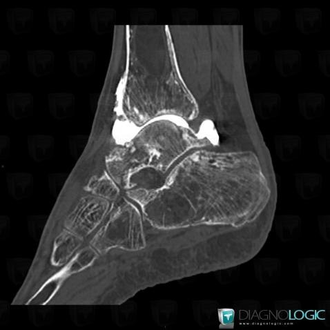 Infarctus osseux, Tibia -inférieur, Scanner