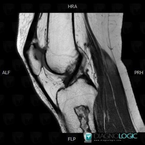 Infarctus osseux, Tibia -supérieur, IRM