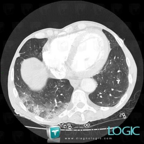 Infarctus pulmonaire, Parenchyme pulmonaire, Scanner