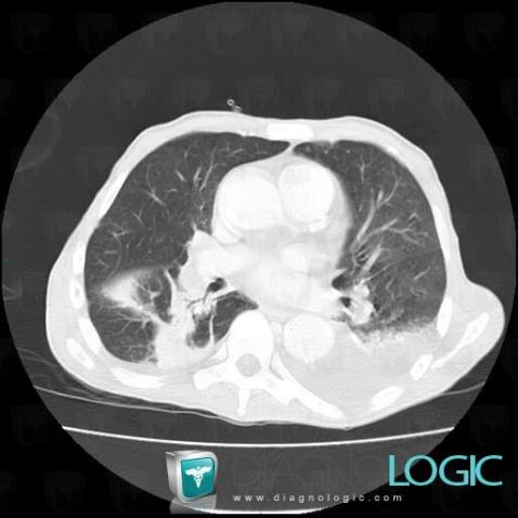 Infarctus pulmonaire, Parenchyme pulmonaire, Scanner