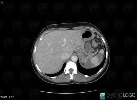 Infarctus splénique, Rate, Scanner