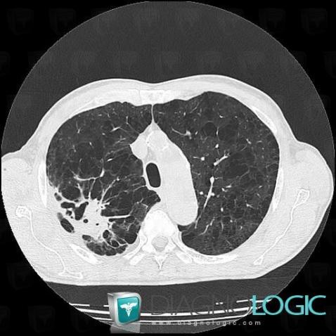 Infection-mycobactéries atypiques, Parenchyme pulmonaire, Scanner