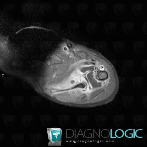 Infectious arthritis, Gleno humeral joint, MRI