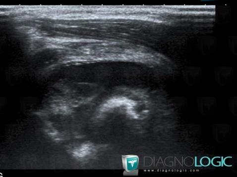 Infectious arthritis, Gleno humeral joint, US