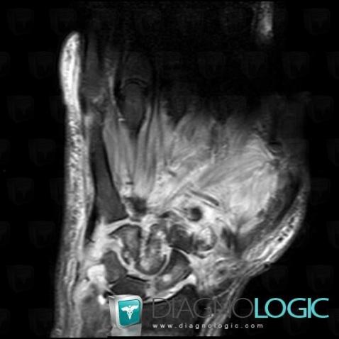 Infectious arthritis, Mediocarpal joint, MRI