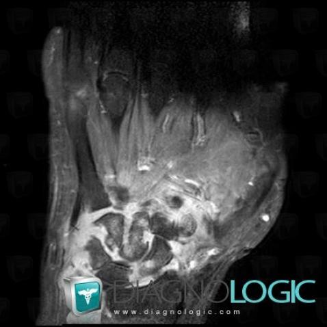 Infectious arthritis, Mediocarpal joint, MRI