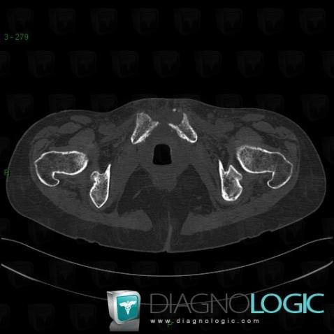 Infectious arthritis, Pubic symphysis, CT