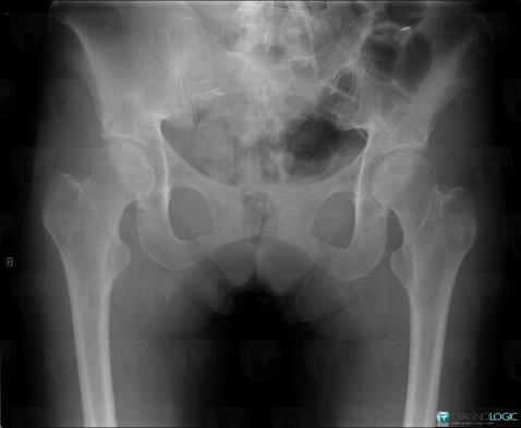 Infectious arthritis, Pubic symphysis, X rays