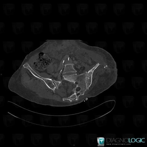 Infectious arthritis, Sacro iliac joint, CT