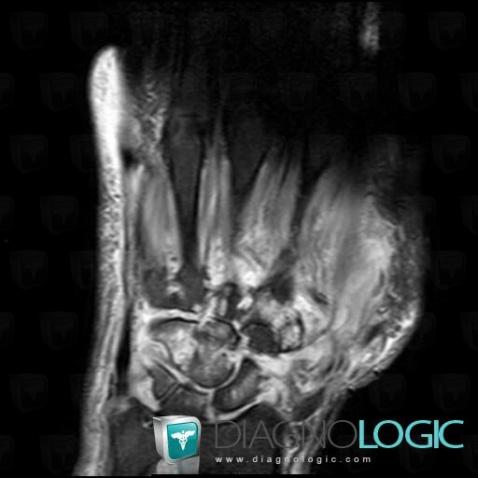 Infectious arthritis, Scaphoid, Lunate, MRI