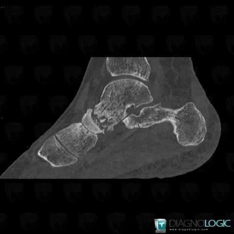 Infectious arthritis, Talo navicular joint, CT