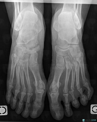 Infectious arthritis, Talus, Navicular, X rays