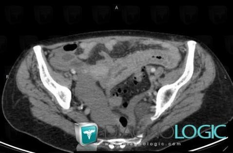 Infectious enteritis, Small bowel, CT