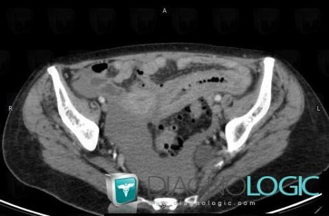 Infectious enteritis, Small bowel, CT