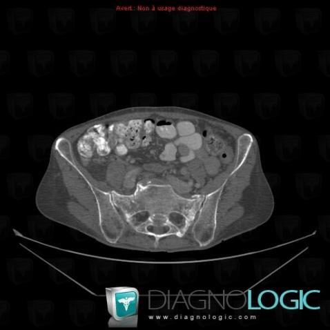 Insufficiency fracture, Sacrum / Coccyx, CT