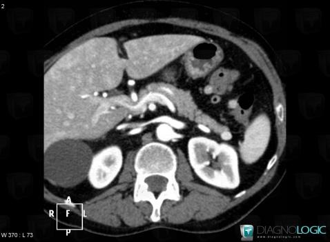 Insulinoma, Pancreas, CT