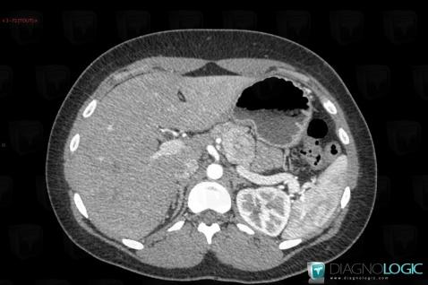 Insulinoma, Pancreas, CT