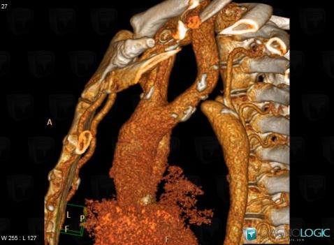 Interrupted aortic arch, Aorta, CT