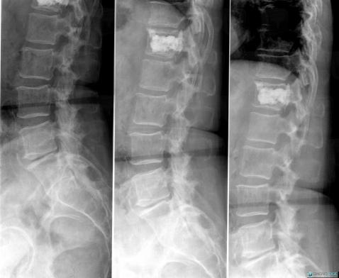 Interventional procedure / cementoplasty, Vertebral body / Disk, X rays