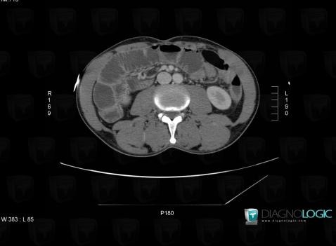 Intestinal malrotation, Colon, CT