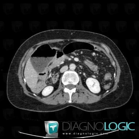 Intestinal malrotation, Mesentery / Peritoneum, CT