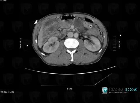 Intestinal malrotation, Small bowel, CT