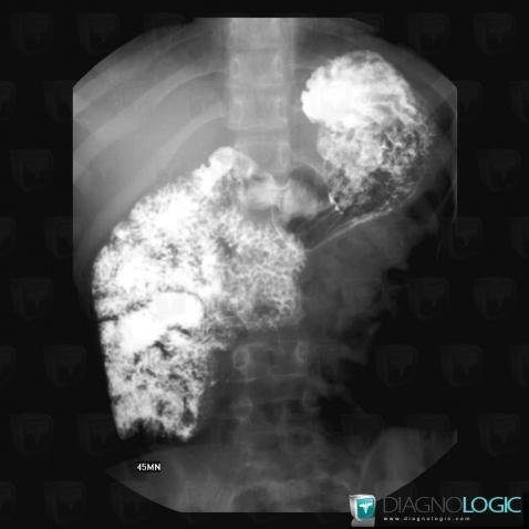 Intestinal malrotation, Small bowel, X rays