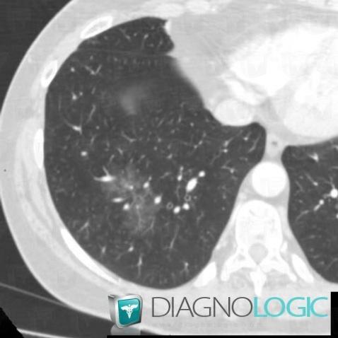 Intra alveolar hemorrhage, Pulmonary parenchyma, CT