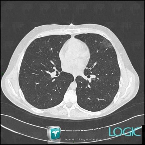 Intra alveolar hemorrhage, Pulmonary parenchyma, CT