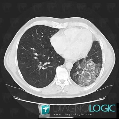 Intra alveolar hemorrhage, Pulmonary parenchyma, CT