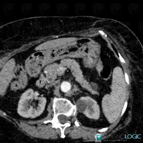 Intraductal papillary mucinous tumor-pancreas, Pancreas, CT
