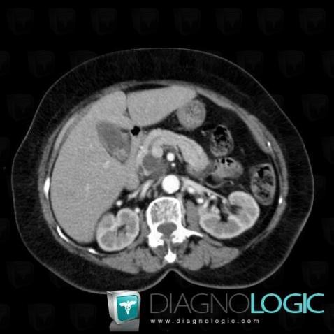 Intraductal papillary mucinous tumor-pancreas, Pancreas, CT