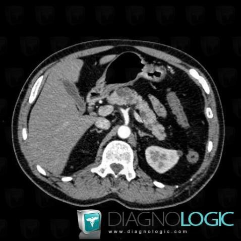 Intraductal papillary mucinous tumor-pancreas, Pancreas, CT