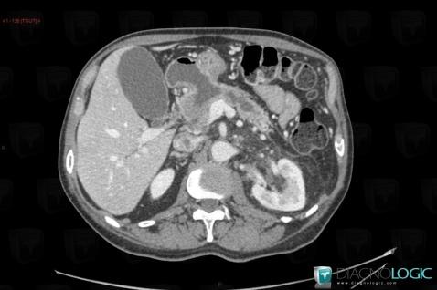 Radiology case : Intraductal papillary mucinous tumor of pancreas (CT ...