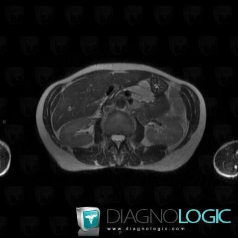 Intraductal papillary mucinous tumor-pancreas, Pancreas, MRI